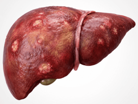Hepatic Encephalopathy: Why Confusion Can Happen in Liver Disease